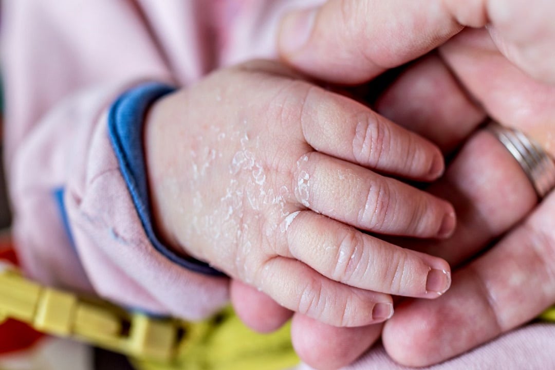 The Top 10 Solutions for Baby Dry Skin